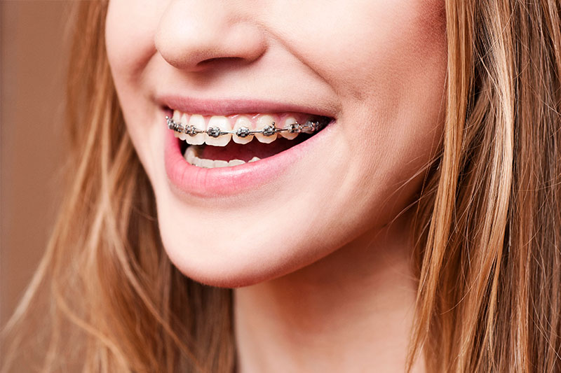 Orthodontics - Smile Dental Works, Schaumburg Dentist
