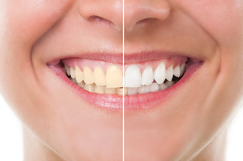 Teeth Whitening - Smile Dental Works, Schaumburg Dentist